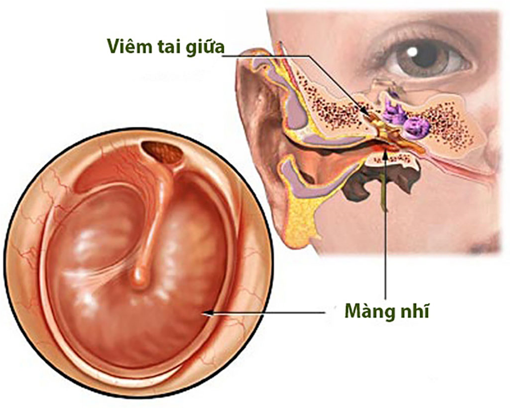 nhan-biet-viem-tai-giua-o-tre-qua-cac-dau-hieu-bieu-hien-1