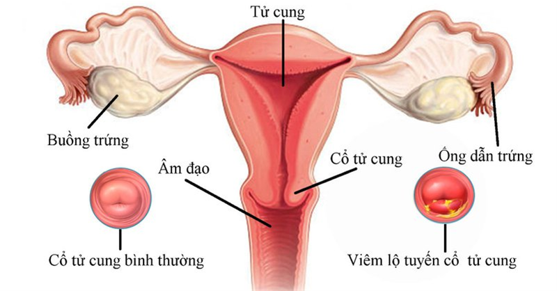 canh-bao-cac-dau-hieu-cua-viem-lo-tuyen-co-tu-cung-qua-tung-giai-doan-1