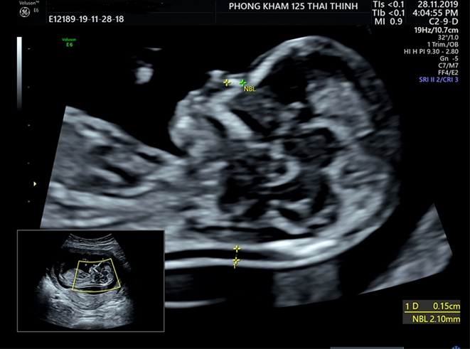 xuong-mui-cua-thai-nhi--chi-so-phat-trien-quan-trong-me-bau-can-chu-y-2