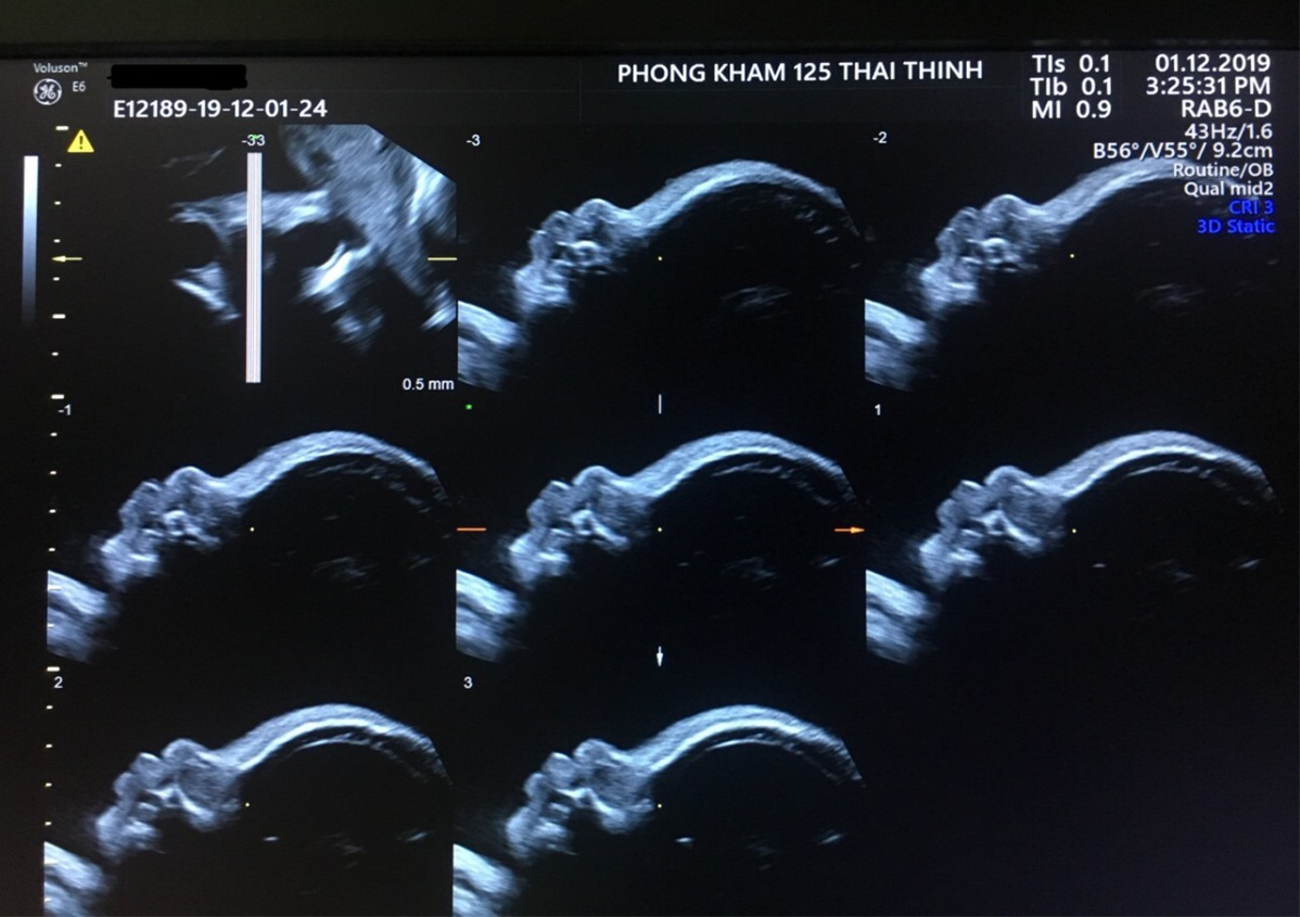 xuong-mui-cua-thai-nhi--chi-so-phat-trien-quan-trong-me-bau-can-chu-y-4