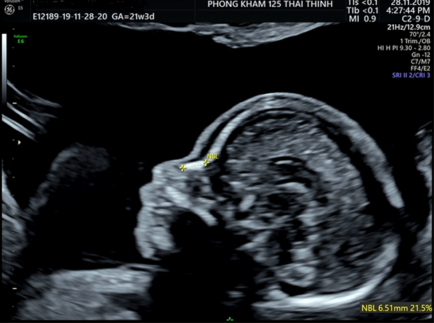 xuong-mui-cua-thai-nhi--chi-so-phat-trien-quan-trong-me-bau-can-chu-y-3