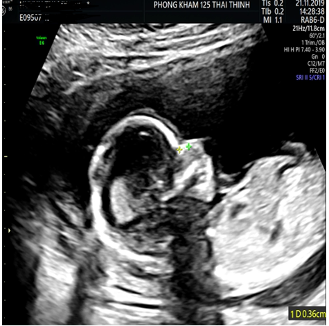 xuong-mui-cua-thai-nhi--chi-so-phat-trien-quan-trong-me-bau-can-chu-y-1