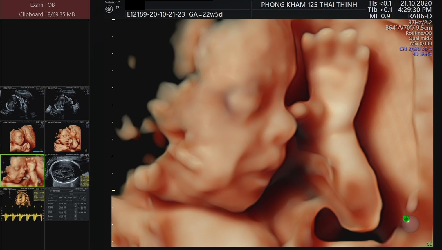 co-hay-khong-hien-tuong-thai-nhi-bi-nac-cut-2