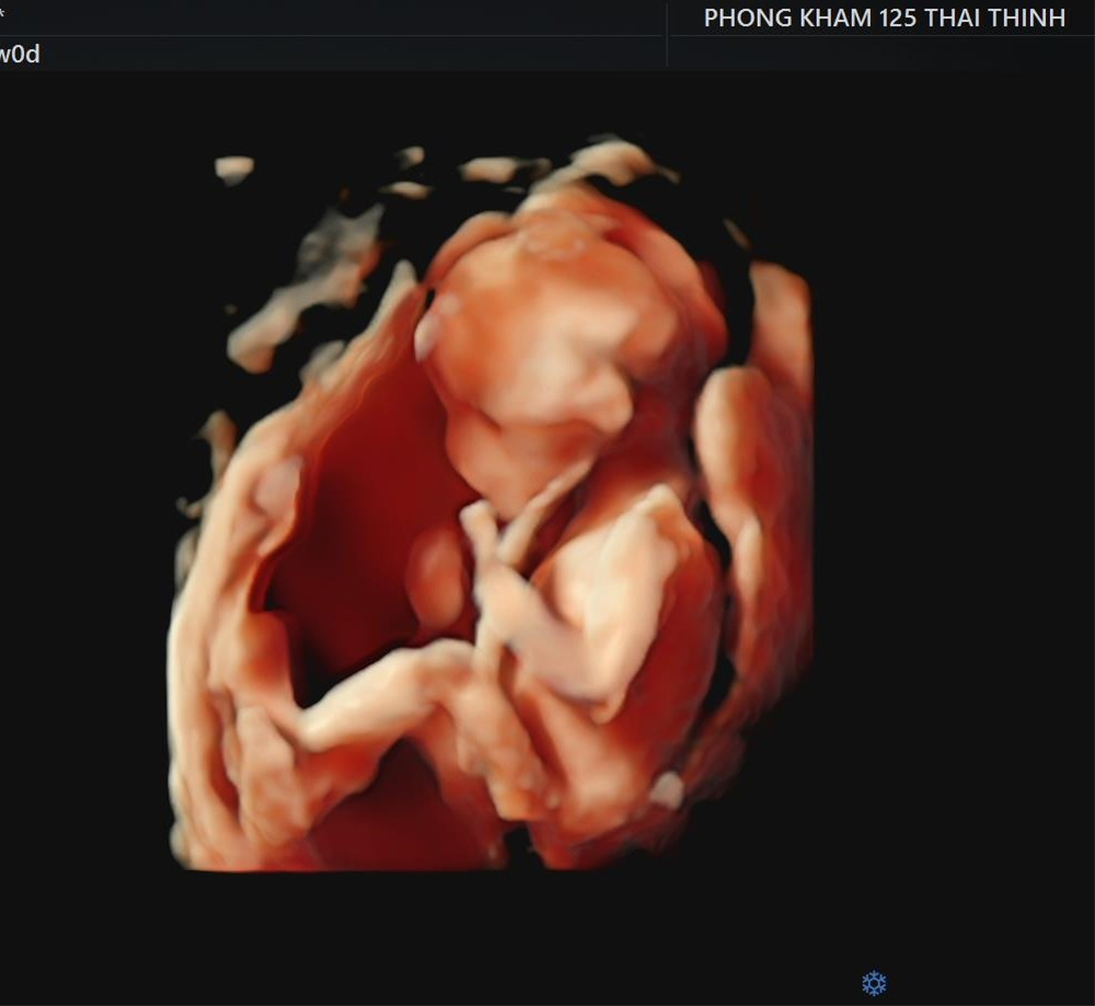 co-hay-khong-hien-tuong-thai-nhi-bi-nac-cut-1