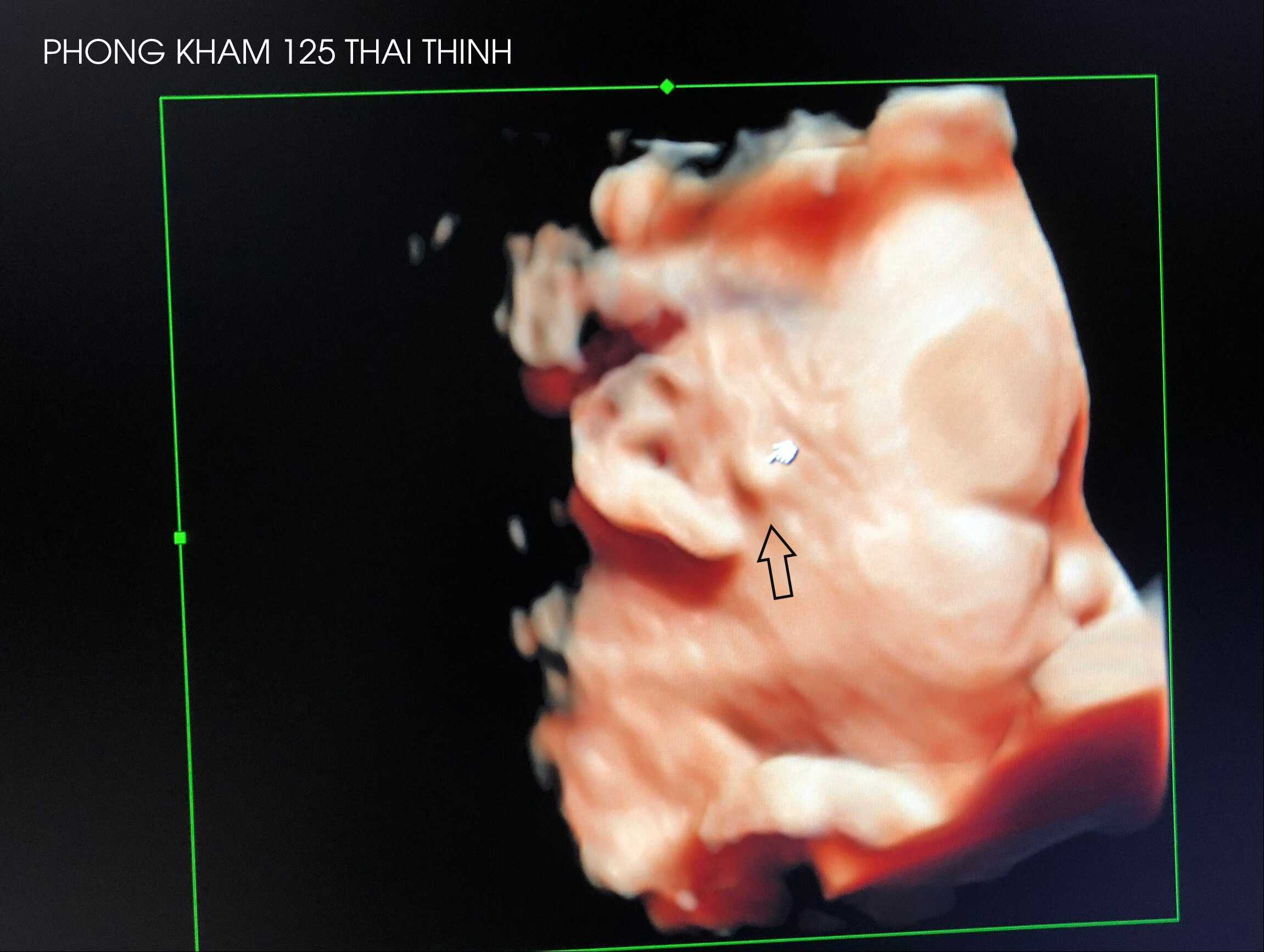 giai-dap-thac-mac-thit-thua-truoc-tai-o-thai-nhi-co-nguy-hiem-khong-1