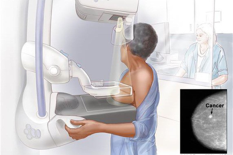 chup-x-quang-tuyen-vu-ung-thu-vu-2