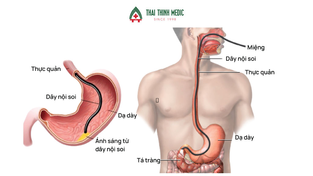 noi-soi-tieu-hoa-nbi