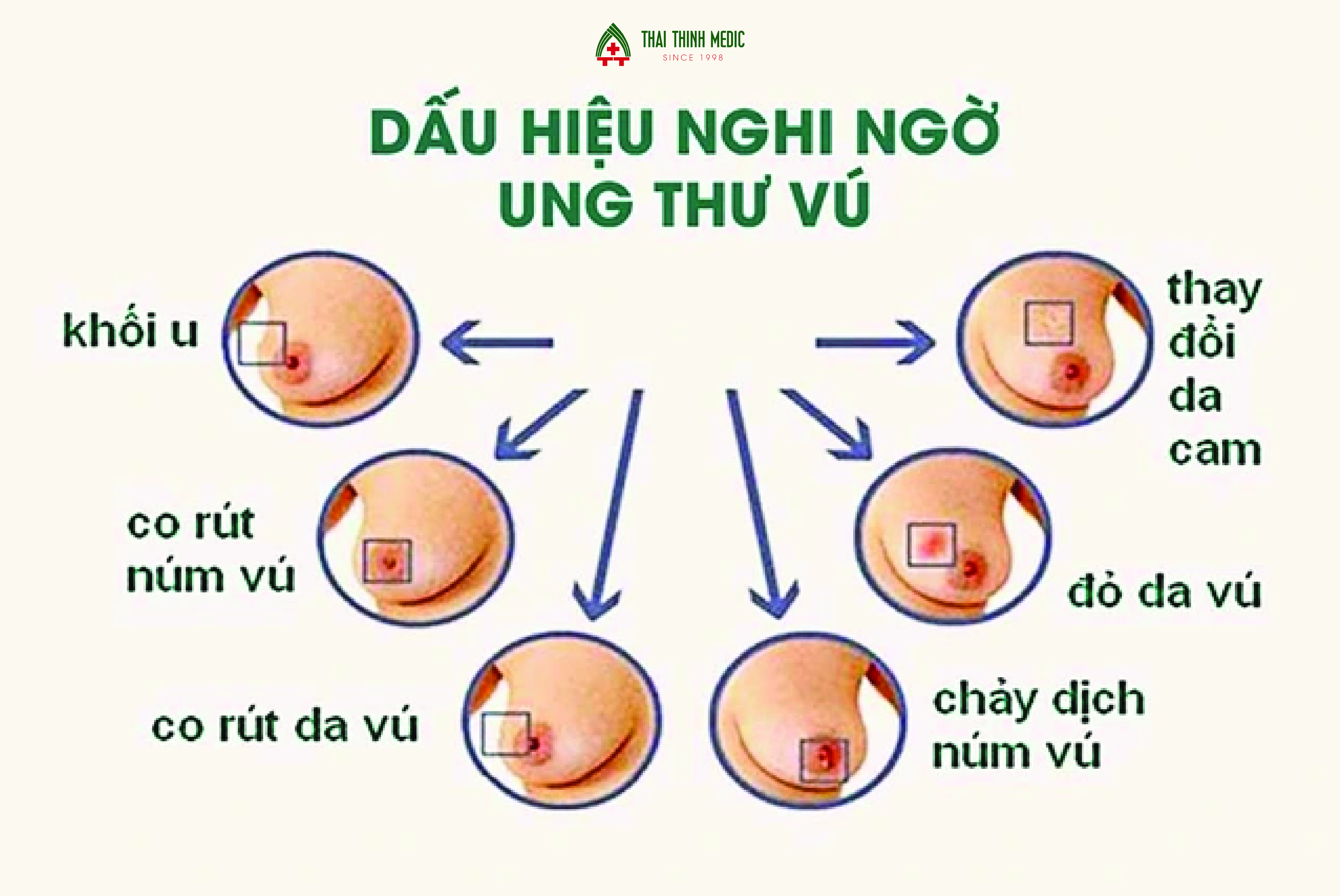 canh-bao-nguy-co-mac-ung-thu-vu-1