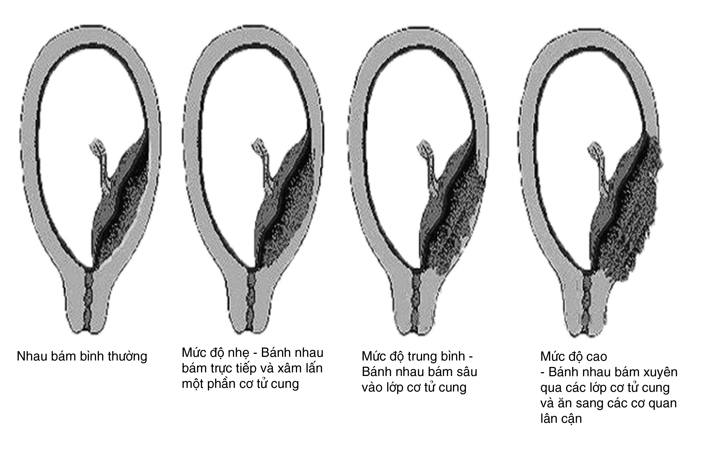 nhau-cai-rang-luoc-co-giu-duoc-tu-cung-khong-3