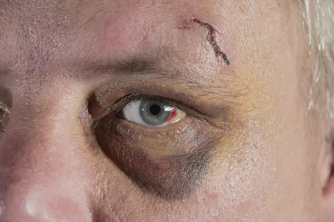 vet-thuong-ham-mat-1