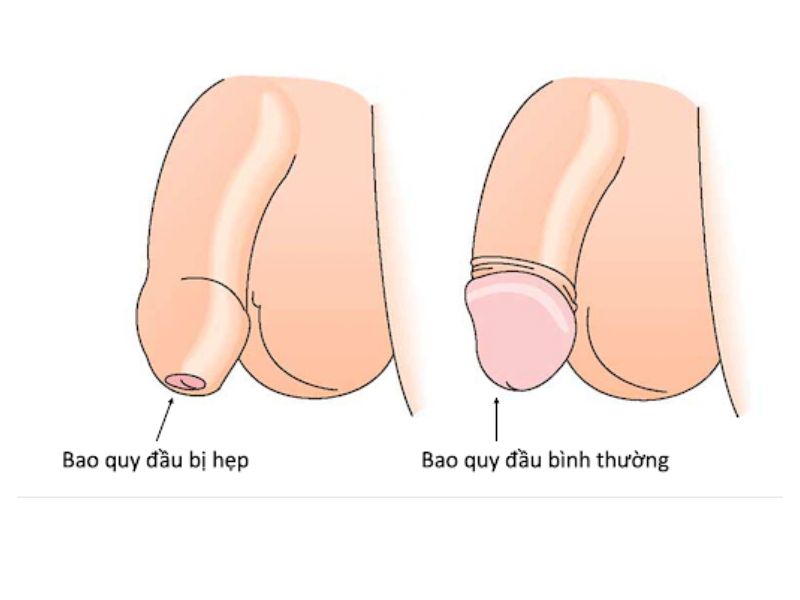 hep-bao-quy-dau-boi-thuoc-gi-2