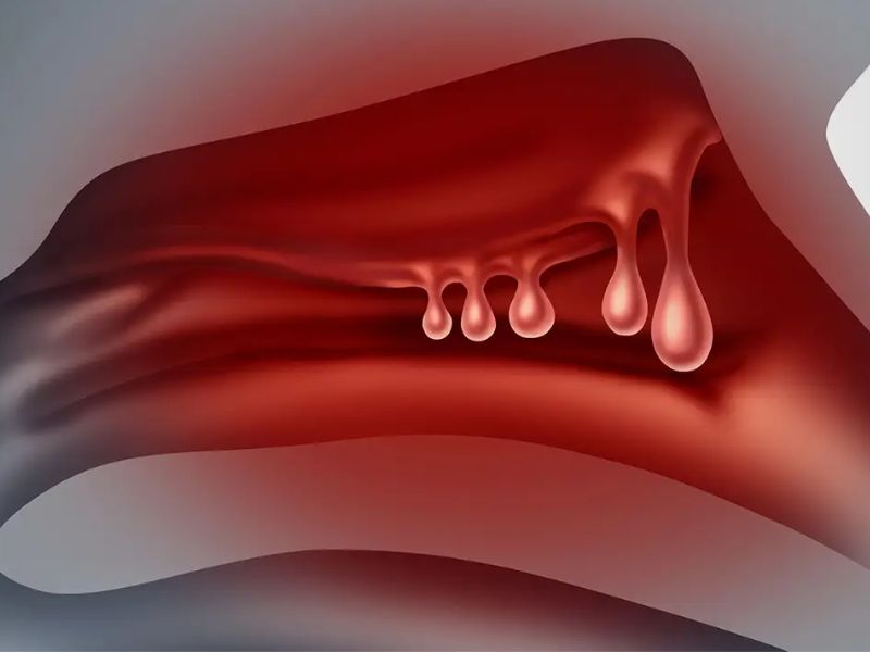 polyp-mui-1
