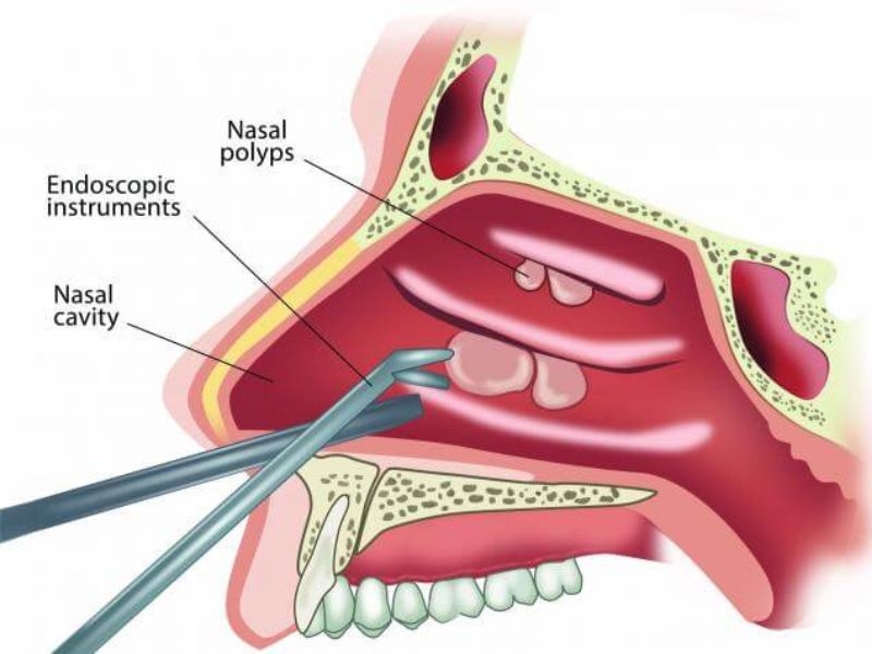 polyp-mui-5