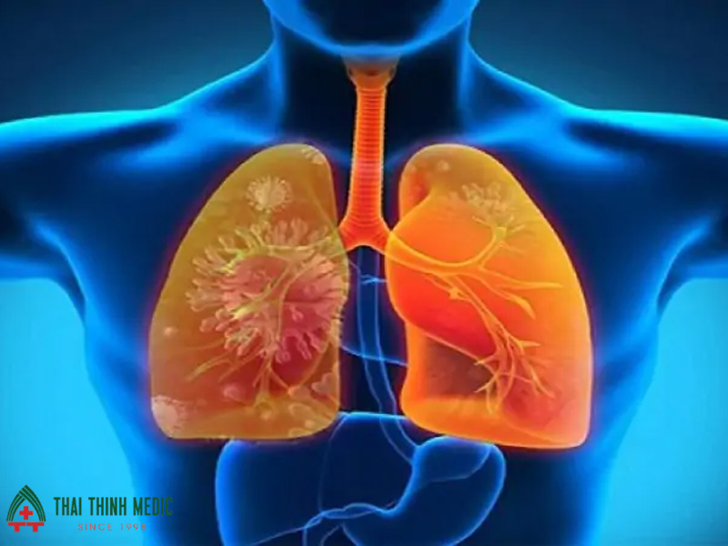 viem-phoi-la-benh-co-ty-le-tu-vong-cao