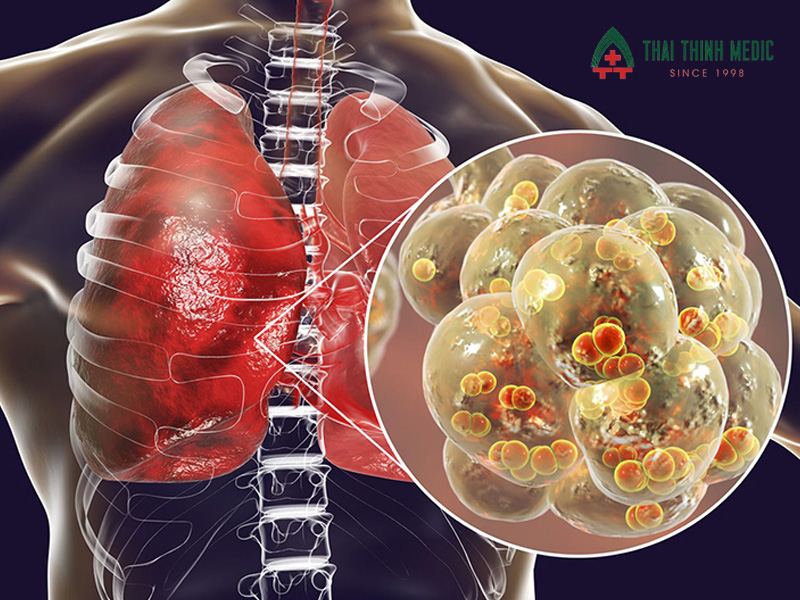 viem-phoi-la-benh-ly-duong-ho-hap-nguy-hiem