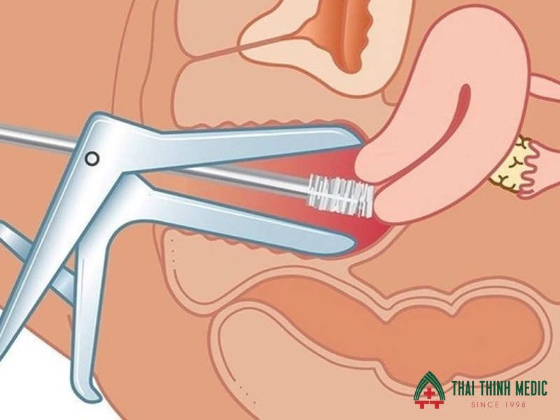 viem-am-dao-co-tu-khoi-khong-kham-dinh-ky