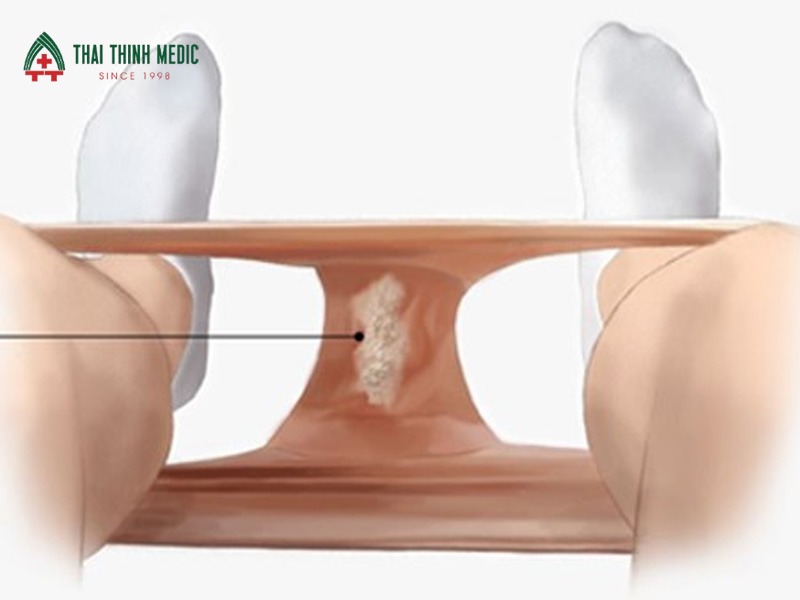 viem-am-dao-do-nam-khi-hu-ba-dau