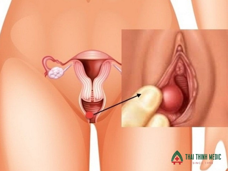 viem-am-dao-do-nam-gay-sung-do