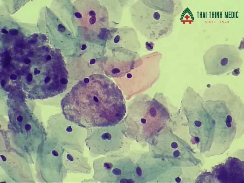 viem-am-dao-do-vi-khuan-nguyen-nhan