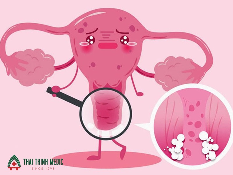 viem-am-dao-do-vi-khuan-benh-nang