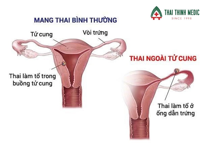 viem-vung-chau-bien-chung