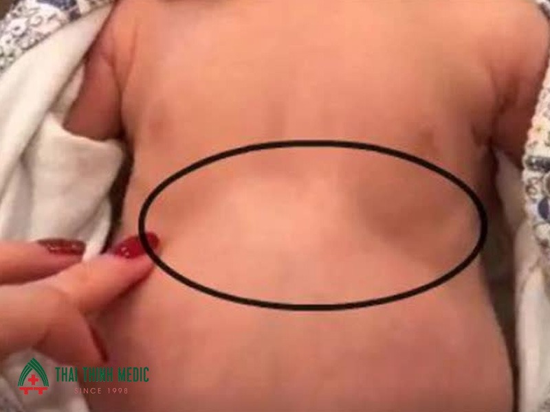 dau-hieu-viem-phoi-nang-co-rut-nguc