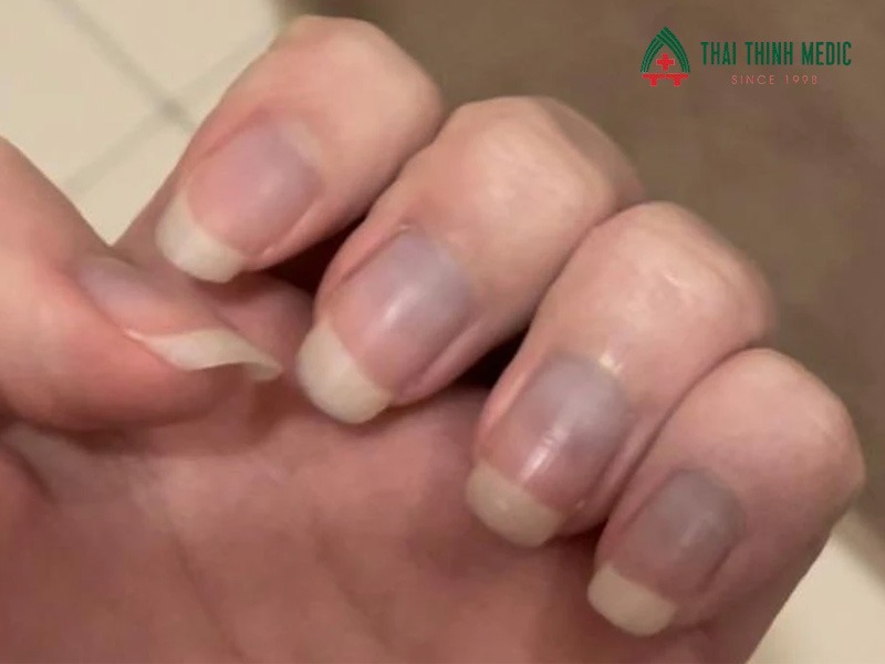 dau-hieu-viem-phoi-nang-tim-tai