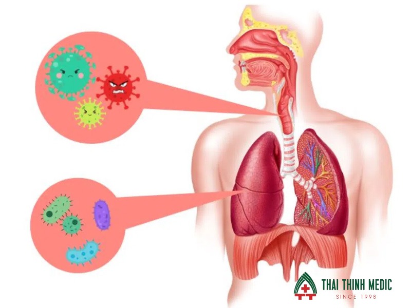 viem-phe-quan-co-lay-khong-do-vi-khuan