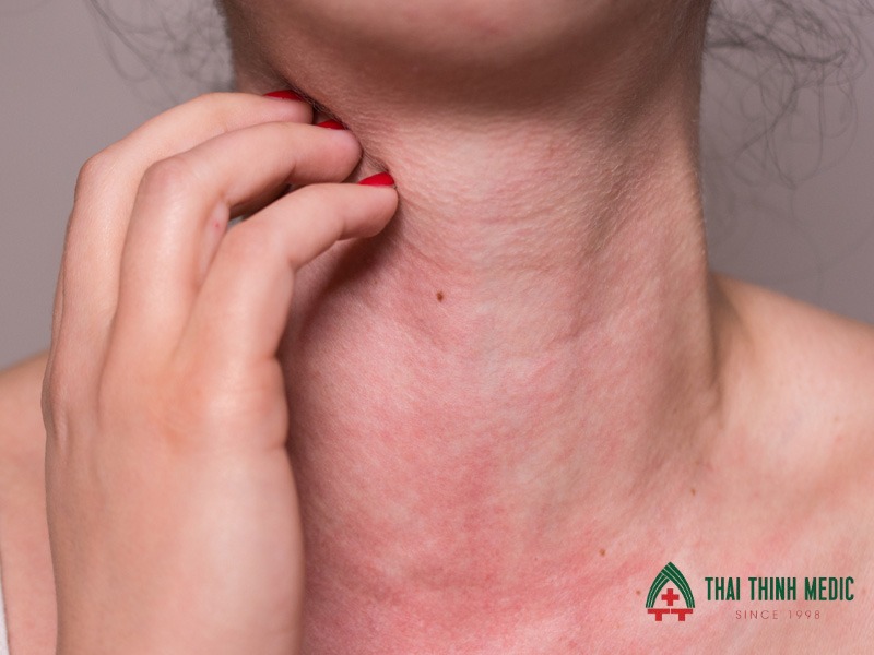 di-ung-thoi-tiet-phan-ung-mien-dich