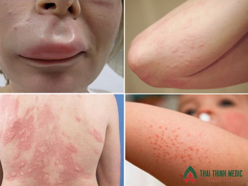 di-ung-thoi-tiet-do-di-truyen