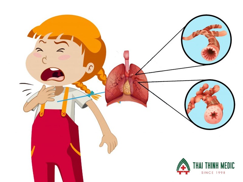 viem-phe-quan-co-lay-khong-cau-hoi