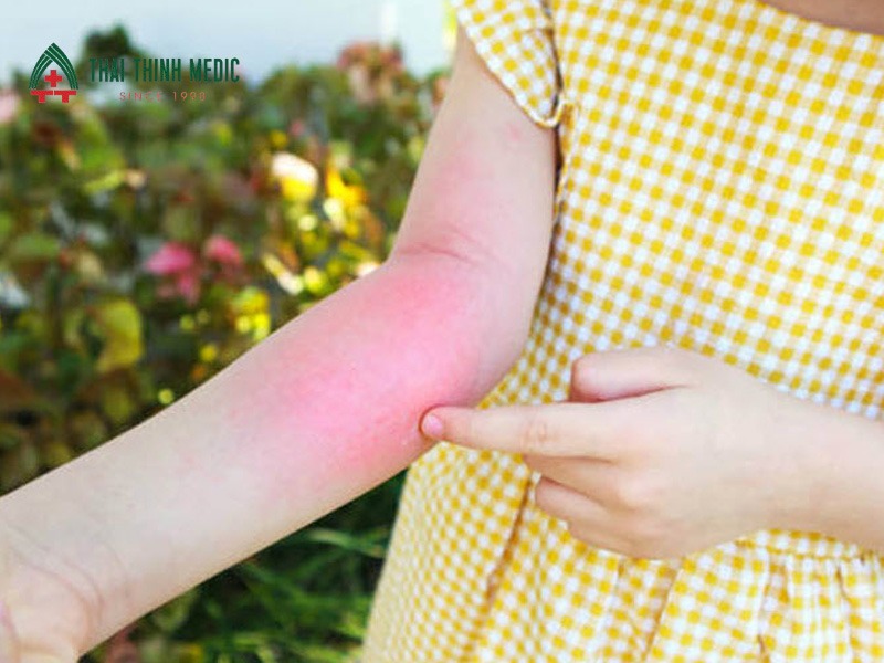 di-ung-thoi-tiet-phan-hoa