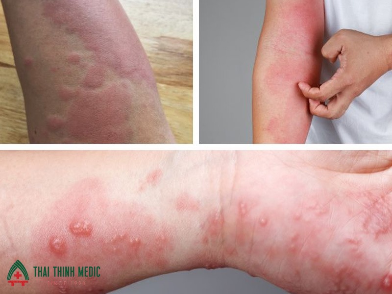 di-ung-thoi-tiet-phan-ung-nghiem-trong