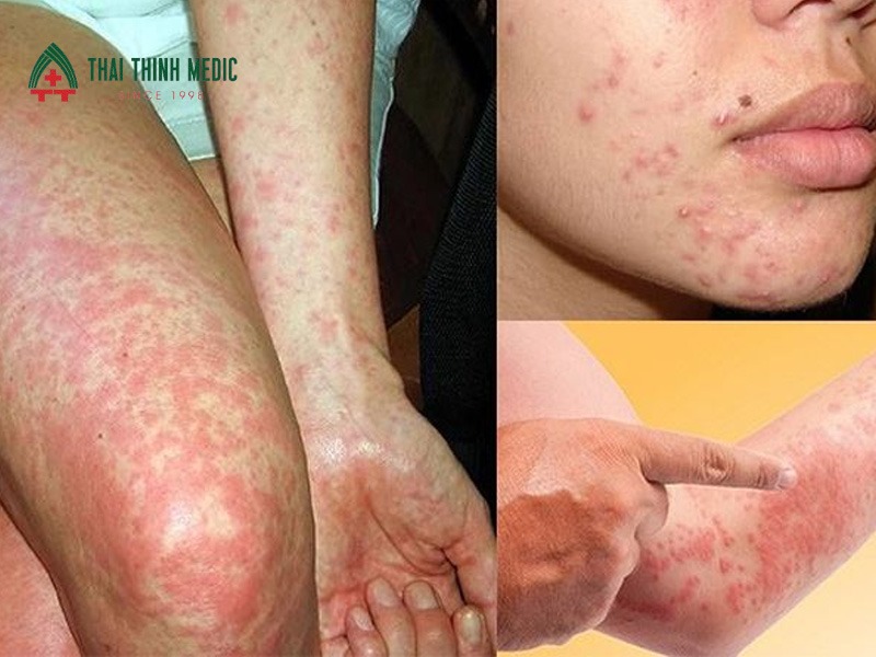 di-ung-thoi-tiet-co-dia