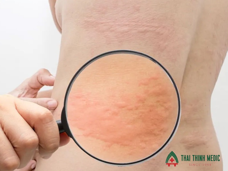 me-day-bao-lau-thi-khoi-co-nguy-hiem-khong