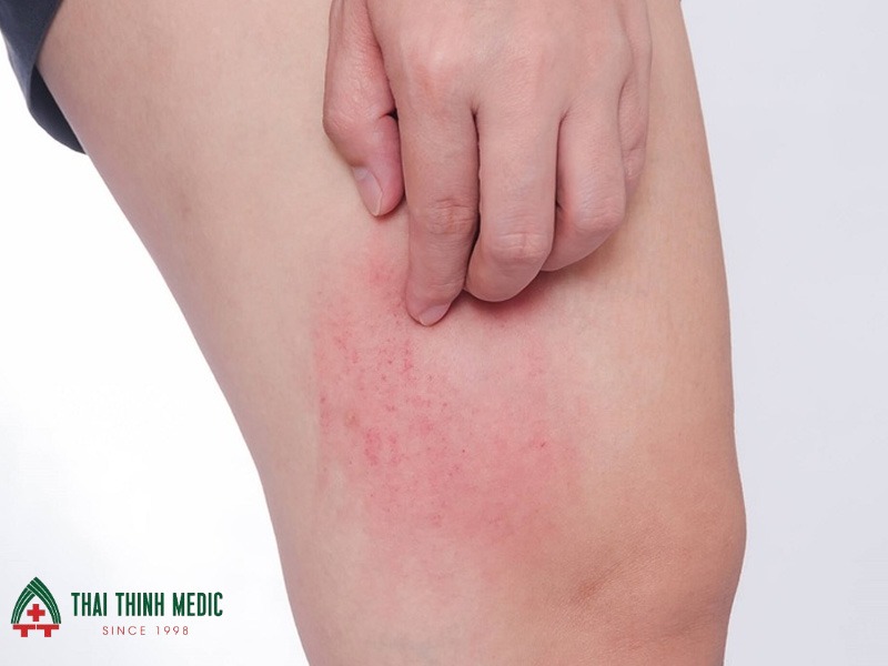 cach-tri-me-day-tai-nha-me-day-nhe