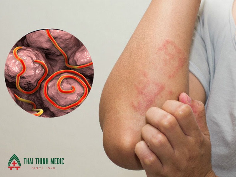 me-day-man-tinh-nhiem-trung