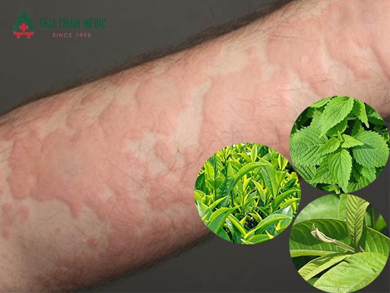 cach-tri-me-day-tai-nha-nguyen-lieu-tu-nhien