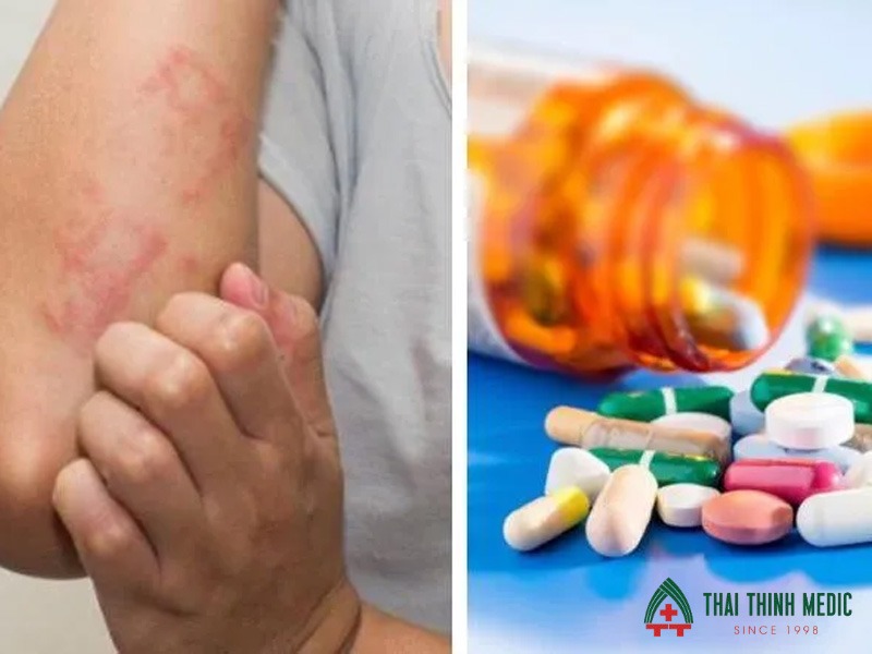 me-day-man-tinh-di-ung-thuoc