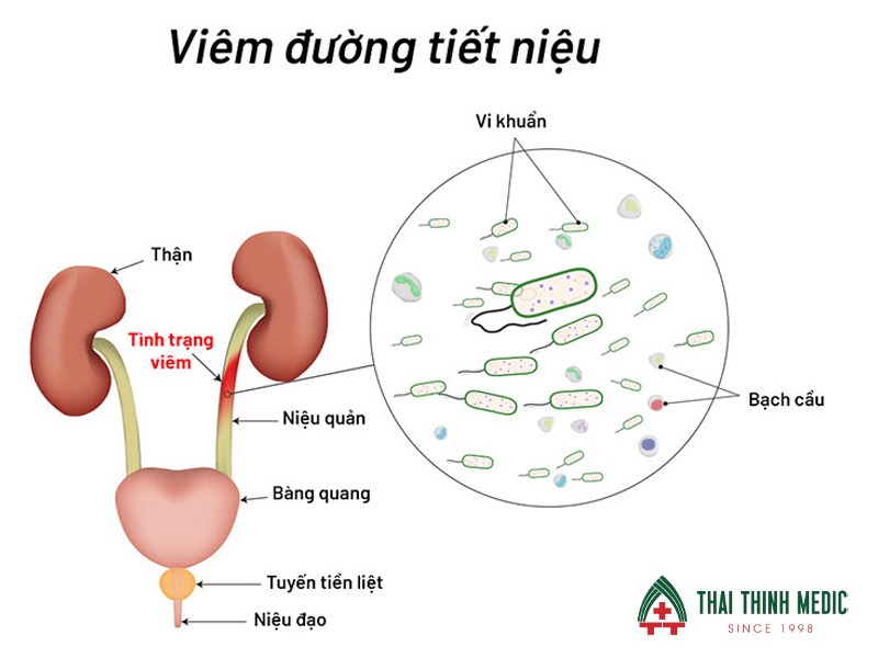 dau-hieu-viem-duong-tiet-nieu