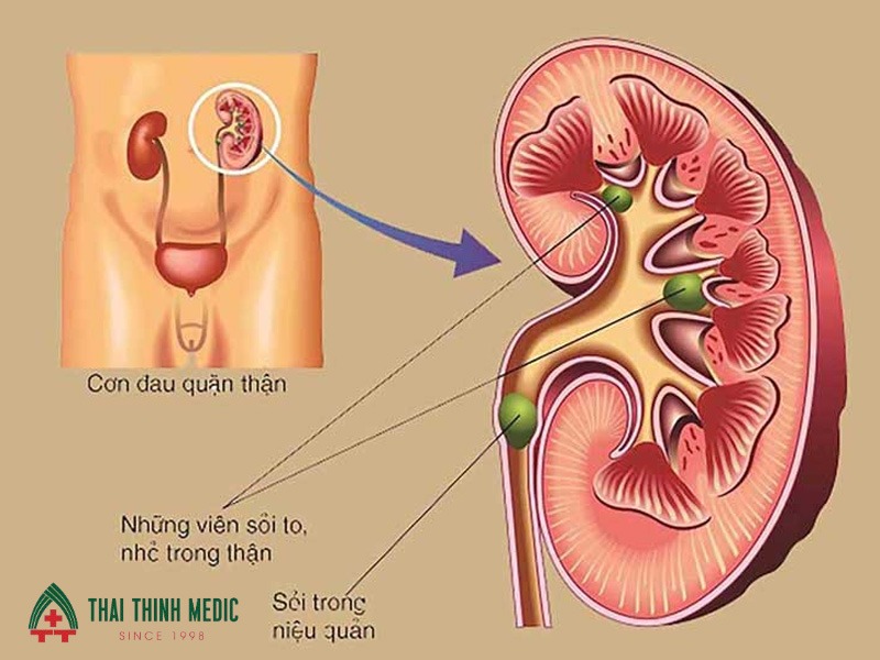 viem-duong-tiet-nieu-benh-ly-nguy-co