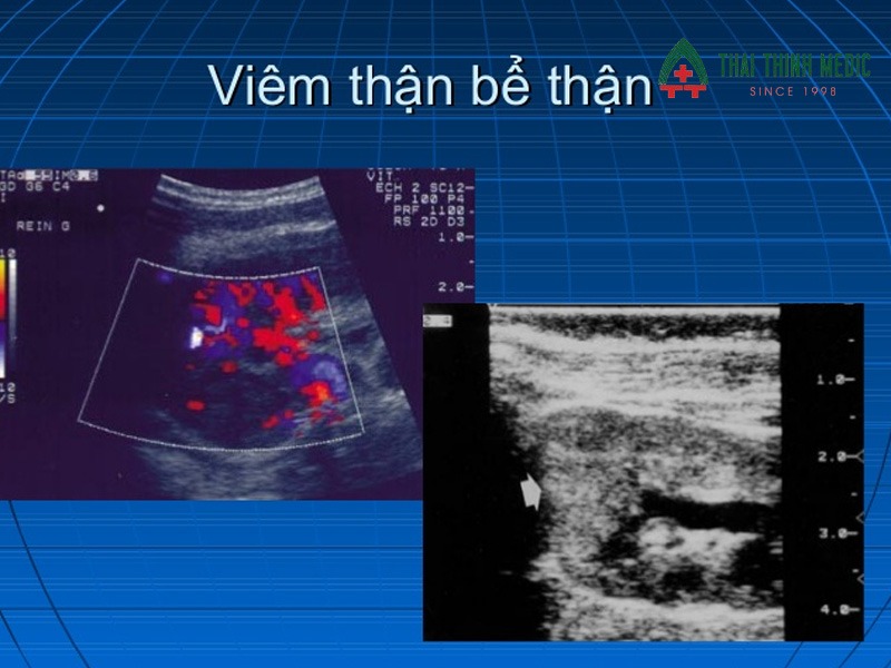 viem-duong-tiet-nieu-co-nguy-hiem-khong-viem-than