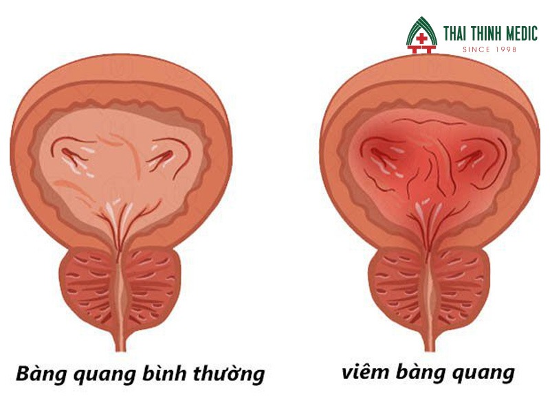 viem-duong-tiet-nieu-co-nguy-hiem-khong-viem-bang-quang