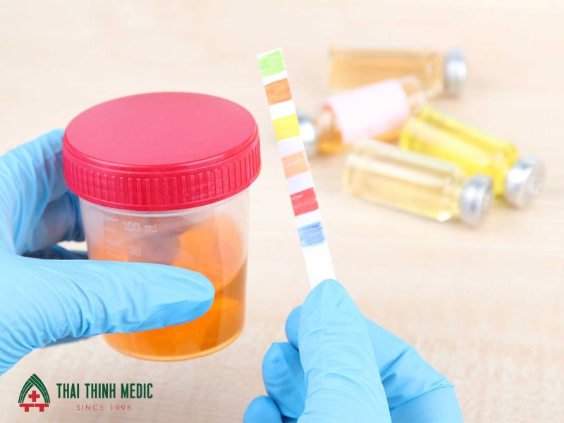viem-duong-tiet-nieu-test-nuoc-tieu