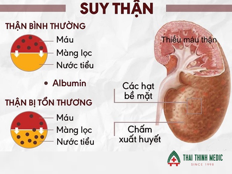 viem-duong-tiet-nieu-co-nguy-hiem-khong-suy-than