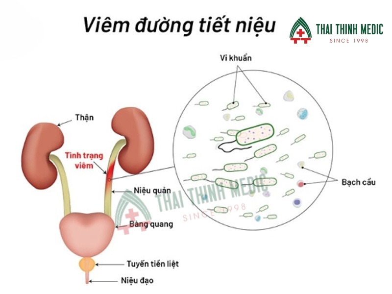viem-duong-tiet-nieu-o-nu-nhiem-vi-khuan