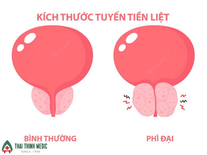 viem-duong-tiet-nieu-o-nam-tien-liet-tuyen