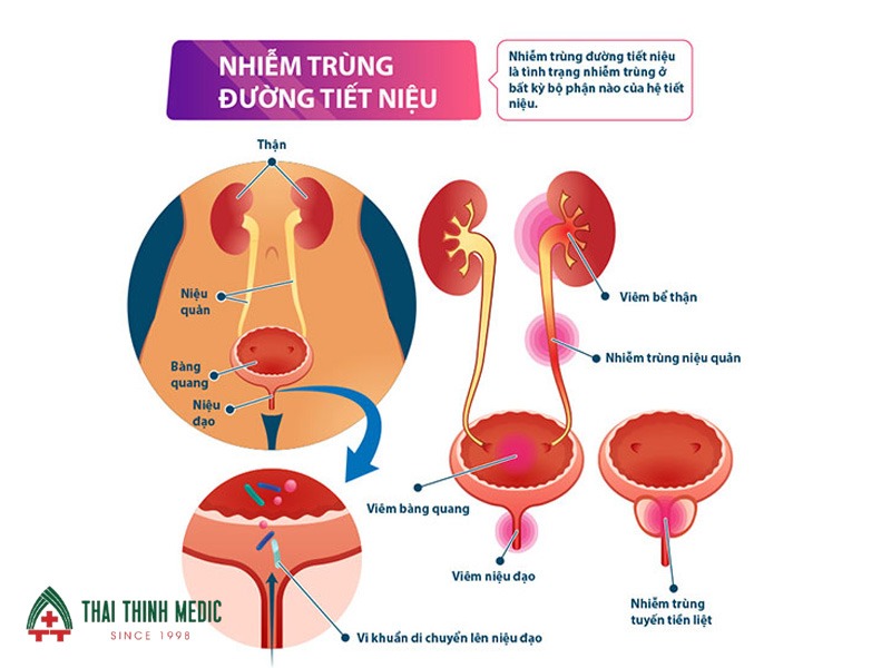 viem-duong-tiet-nieu-o-nam-nhiem-trung
