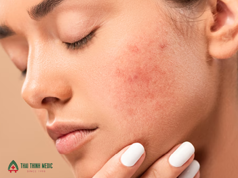 cach-tri-mun-noi-tiet-treatment