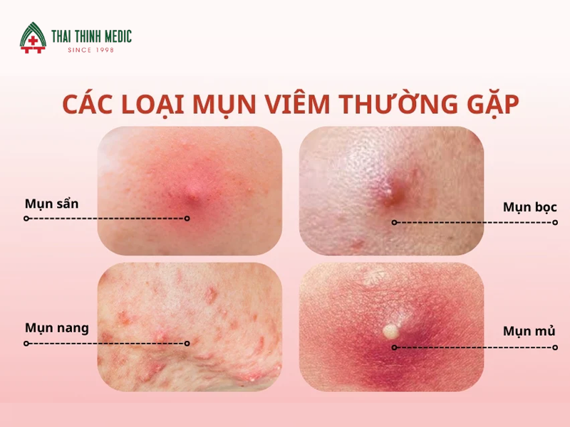 cac-loai-mun-mun-viem-do